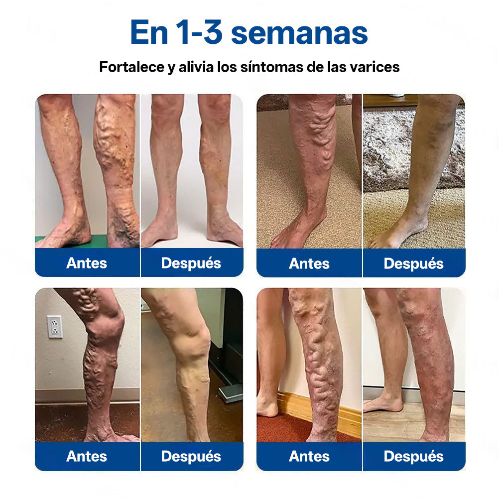 Tainun® VeinTarget Parche de Microagujas Herbal para las Venas 🌿 El primer parche de microagujas con hierbas alpinas certificado por la Unión Europea 🇪🇺 Clínicamente probado con una tasa de éxito de hasta el 96% 📊 Resultados visibles en 7–14 días 🔥