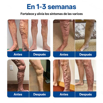 Tainun® VeinTarget Parche de Microagujas Herbal para las Venas 🌿 El primer parche de microagujas con hierbas alpinas certificado por la Unión Europea 🇪🇺 Clínicamente probado con una tasa de éxito de hasta el 96% 📊 Resultados visibles en 7–14 días 🔥