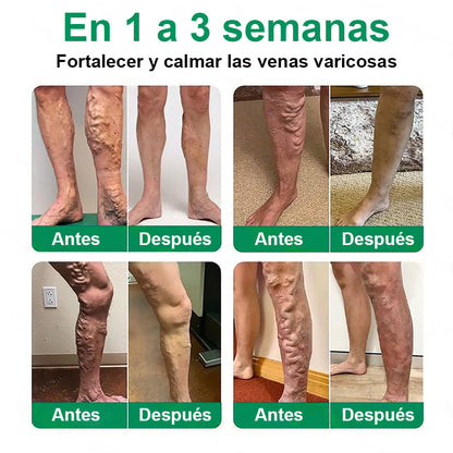 Twisma® VeinTarget – parche avanzado con microtecnología para varices 🦵🔥 Resultados visibles en solo 7–14 días  ⚡ 96 % de eficacia clínicamente comprobada 🌿 Efecto de apoyo suave para piernas más ligeras y relajadas 💪